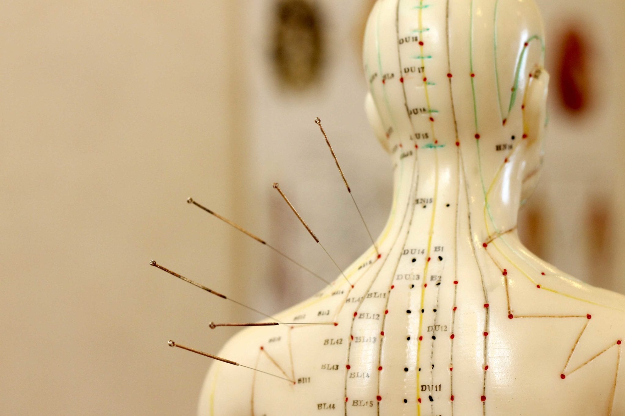 Accupuncture